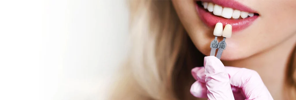 لمینت دندان پوسیده