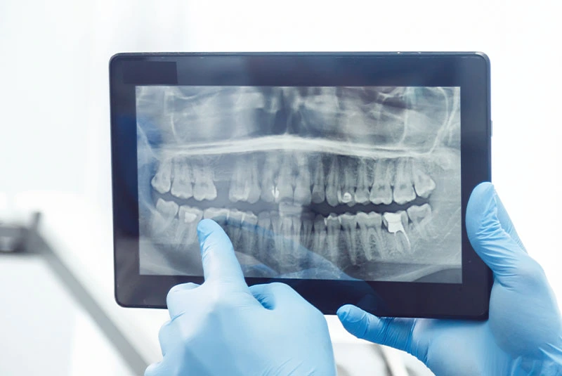 اسکن فک برای ایمپلنت