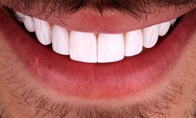 لمینت دندان